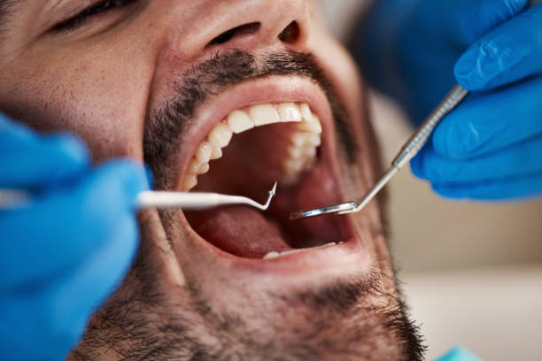 Best Emergency Dental Care for Broken or Chipped Teeth in Madison, IN